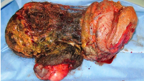 The “twin” tumor, taken out of the girl’s body.
